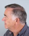 After Hair Transplant&nbsp;Front